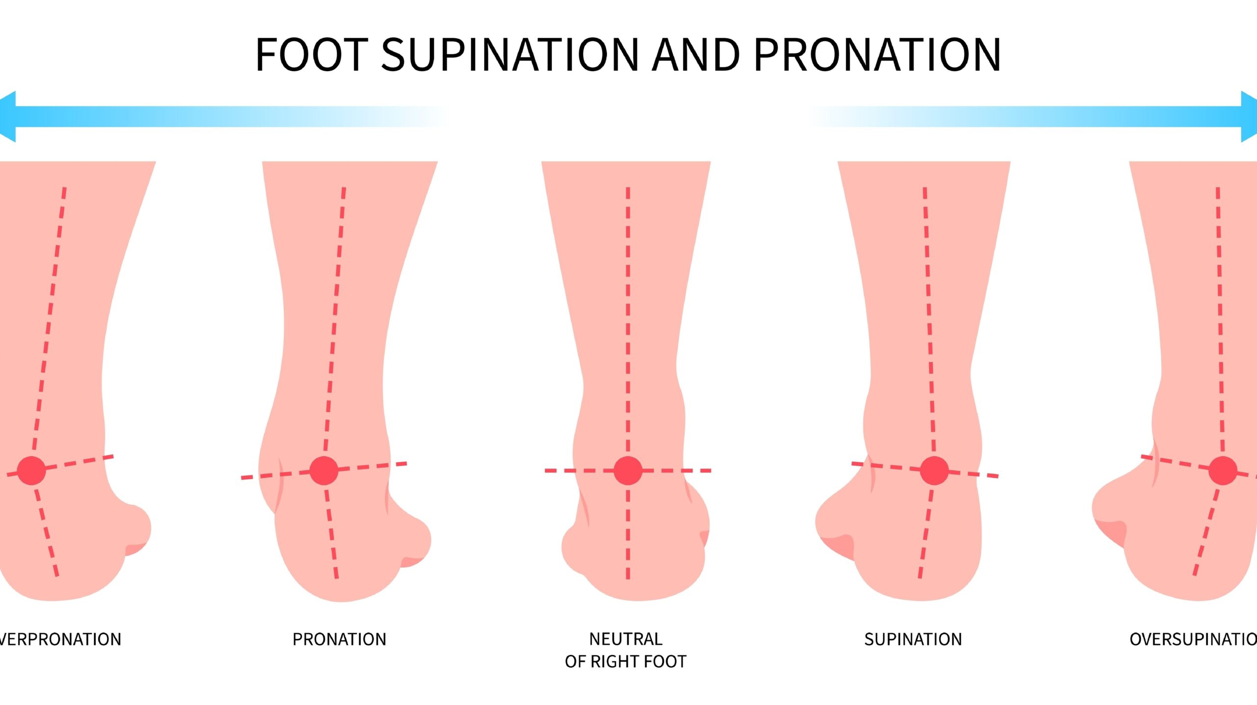 Foot Pronation