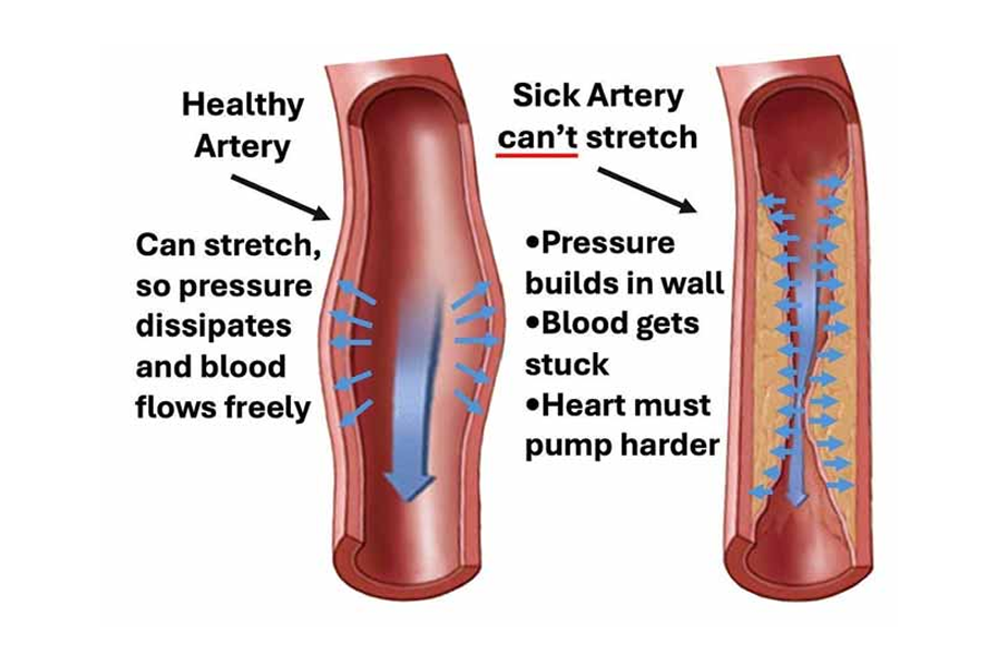 Healthy Artery Sick Artery